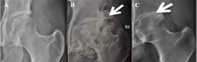 A Comprehensive Assessment of Hip Damage in Ankylosing Spondylitis, Especially Early Features